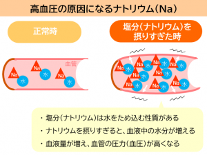 高血圧の原因になるナトリウム